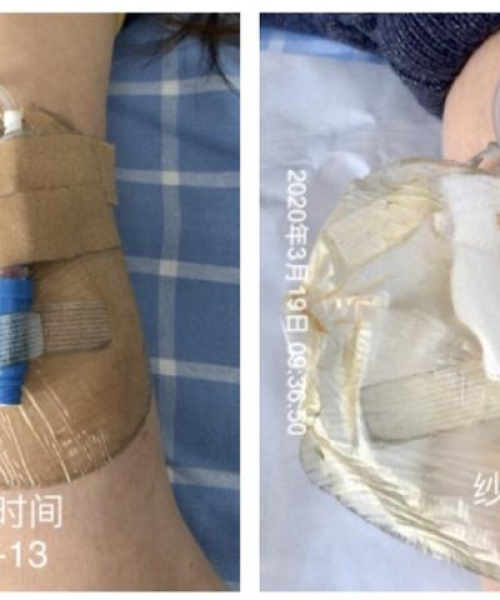揭秘伤口愈合缓慢之谜，原因何在？百度为您解答疑惑