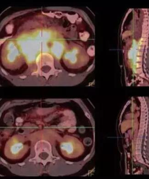 百度解读HPV阳性，揭秘HPV45阳性背后的真相！